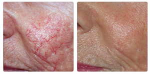 Depilación láser facial y corporal (Precio en la descripción)