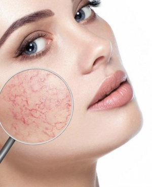 Mezoterapija ROSAcea