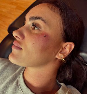 Microdermal piercing