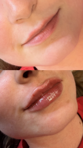 Kyselina hyalurónová - 1ml