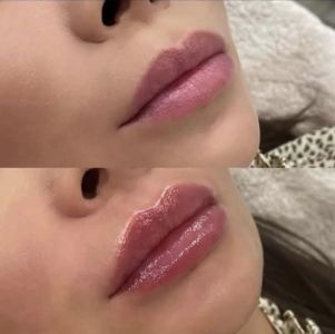 Kyselina hyalurónová - 0,5ml 