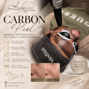 Carbon peel (laserový peeling)